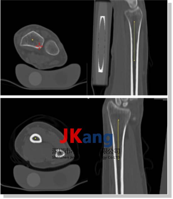 QRM-BMF 前臂模型,Forearm Phantom (BMF)前臂模体